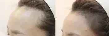 半永久化妝是微整形嗎？兩者有什么區(qū)別？