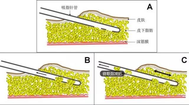 半永久化妝是微整形嗎？兩者有什么區(qū)別？